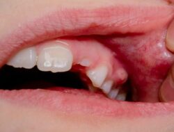 Waspada Tanda Diabetes di Mulut: Dari Gusi Kering hingga Bau Tak Sedap